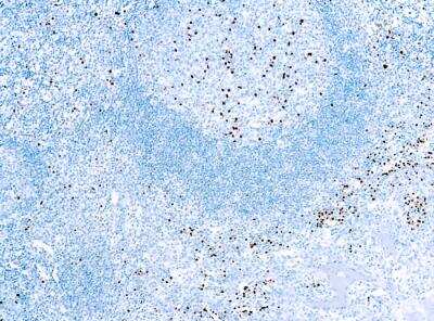 Immunohistochemistry-Paraffin: MUM1 Antibody (MUM1p) [NB200-356] - Formalin fixed paraffin embedded human tonsil stained with MUM1 protein antibody (NB200-356).