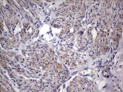 Immunohistochemistry: MURF3 Antibody (7F8) [NBP2-46224] - Analysis of Adenocarcinoma of Human endometrium tissue.