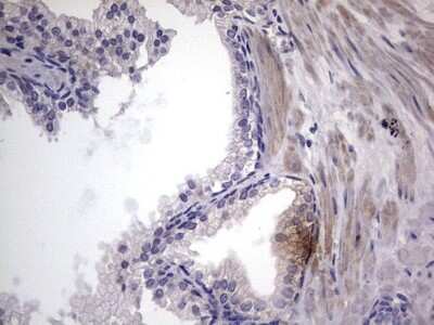 Immunohistochemistry: MURF3 Antibody (7F8) [NBP2-46224] - Analysis of Carcinoma of Human prostate tissue.