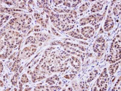 Immunohistochemistry-Paraffin: MVK Antibody [NBP1-32868] - Paraffin-embedded A549 xenograft, using antibody at 1:500 dilution.