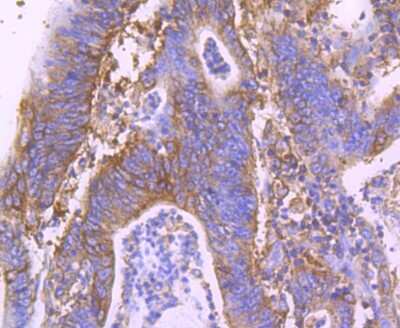 Immunohistochemistry-Paraffin: MVP Antibody (JM74-73) [NBP2-75579] - Analysis of paraffin-embedded human colon cancer tissue using anti-MVP antibody. Counter stained with hematoxylin.