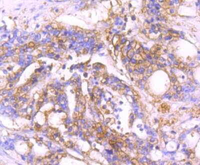 Immunohistochemistry-Paraffin: MVP Antibody (JM74-73) [NBP2-75579] - Analysis of paraffin-embedded human stomach cancer tissue using anti-MVP antibody. Counter stained with hematoxylin.