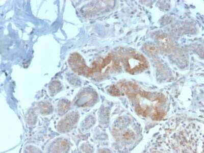 Immunohistochemistry-Paraffin: MVP Antibody (VP2897R) - Azide and BSA Free [NBP3-08801] - Formalin-fixed, paraffin-embedded human Breast Carcinoma stained with MVP Rabbit Recombinant Monoclonal Antibody (VP2897R).