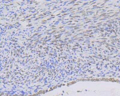 Immunohistochemistry: MYST1 Antibody (JG36-05) [NBP2-76844] - Immunohistochemical analysis of paraffin-embedded human cervix cancer tissue using anti-KAT8 antibody. Counter stained with hematoxylin.