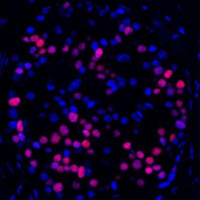 Immunohistochemistry-Paraffin: MafA Antibody (BLR067G) [NBP2-78707] - Detection of human MafA (red) in FFPE pancreatic carcinoma by IHC-IF using this antibody. Secondary: HRP-conjugated goat anti-rabbit IgG (NB100-2332). Substrate: Opal™. Counterstain: DAPI (blue).