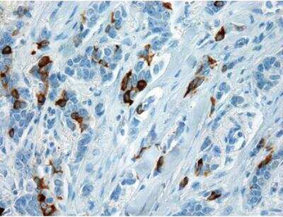 Immunohistochemistry-Paraffin: Mammaglobin A Antibody (EPR9092) [NBP2-41752] - Formalin fixed paraffin embedded human breast carcinoma stained with Mammaglobin A antibody.