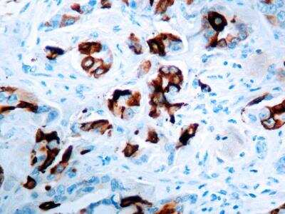 Immunohistochemistry-Paraffin: Mammaglobin A Antibody (EPR9092) [NBP2-41752] - Formalin fixed paraffin embedded human breast carcinoma stained with Mammaglobin A antibody. (NBP2-41752)