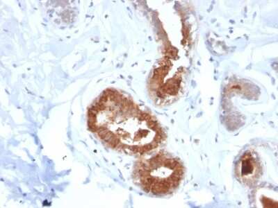 Immunohistochemistry-Paraffin: Mammaglobin A Antibody (MGB/2123R) - Azide and BSA Free [NBP3-08514] - Formalin-fixed, paraffin-embedded human breast carcinoma stained with Mammaglobin A Antibody MGB/2123R.