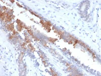 Immunohistochemistry-Paraffin: Mammaglobin A Antibody (MGB/2123R) - Azide and BSA Free [NBP3-08514] - Formalin-fixed, paraffin-embedded human breast carcinoma stained with Mammaglobin A antibody (MGB/2123R).