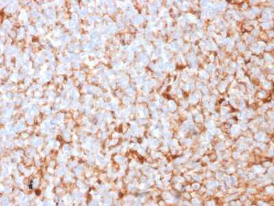 Immunohistochemistry-Paraffin: Mammaglobin A Antibody (MGB/2682R) - Azide and BSA Free [NBP3-08525] - Formalin-fixed, paraffin-embedded human breast carcinoma stained with Mammaglobin A Recombinant Rabbit Monoclonal Antibody (MGB/2682R).