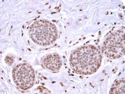 Immunohistochemistry-Paraffin: Mammaglobin A Antibody (MGB/2682R) - Azide and BSA Free [NBP3-08525] - Formalin-fixed, paraffin-embedded human breast carcinoma stained with Mammaglobin A Recombinant Rabbit Monoclonal Antibody (MGB/2682R).