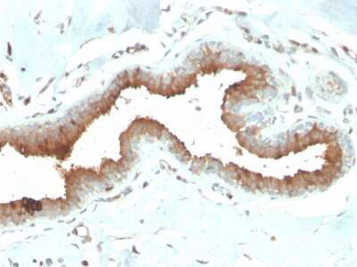 Immunohistochemistry-Paraffin: Mammaglobin A Antibody (MGB/2704) - Azide and BSA Free [NBP3-08429] - Formalin-fixed, paraffin-embedded human breast carcinoma stained with Mammaglobin A Mouse Monoclonal Antibody (MGB/2704).