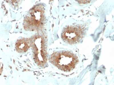Immunohistochemistry-Paraffin: Mammaglobin A Antibody (MGB/4057R) [NBP3-08526] - Formalin-fixed, paraffin-embedded human breast carcinoma stained with Mammaglobin A Recombinant Rabbit Monoclonal Antibody (MGB/4057R).