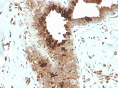 Immunohistochemistry-Paraffin: Mammaglobin A Antibody (MGB/4057R) [NBP3-08526] - Formalin-fixed, paraffin-embedded human breast carcinoma stained with Mammaglobin A Recombinant Rabbit Monoclonal Antibody (MGB/4057R).