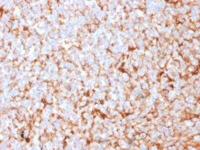 Immunohistochemistry-Paraffin: Mammaglobin A Antibody (SPM518) - Azide and BSA Free [NBP2-79864] - Formalin-fixed, paraffin-embedded human Breast Carcinoma stained with Monospecific Mouse Monoclonal Antibody (SPM518) to Mammaglobin.