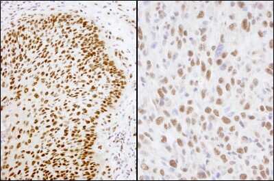 Immunohistochemistry: Matrin 3 Antibody [NB100-1559] - Sample: FFPE section of human laryengeal squamous cell carcinoma (left) and mouse squamous cell carcinoma (right). Antibody: Affinity purified rabbit anti- Matrin 3 used at a dilution of 1:1,000 (1ug/ml). Detection: DAB