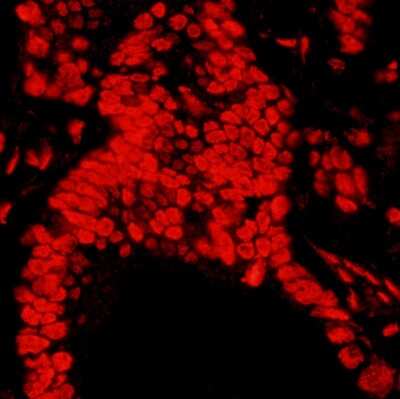 Immunohistochemistry: Matrin 3 Antibody [NB100-1761] - Sample: FFPE section of human stomach carcinoma. Antibody: Affinity purified rabbit anti-Matrin 3 used at a dilution of 1:400 (0.5ug/ml). Detection: Red-fluorescent Goat anti-Rabbit IgG-heavy and light chain cross-adsorbed Antibody DyLight 594 Conjugated