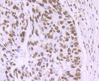 Immunohistochemistry-Paraffin: Matrin 3 Antibody (JU93-43) [NBP2-75567] - Analysis of paraffin-embedded human lung cancer tissue using anti-Matrin 3 antibody. Counter stained with hematoxylin.