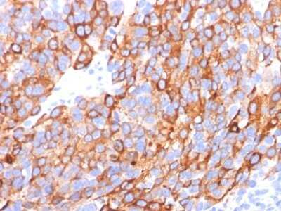 Immunohistochemistry-Paraffin: Melan-A/MART-1 Antibody (A103 + M2-7C10 + M2-9E3) - IHC-Prediluted [NBP2-44392] - Formalin-fixed, paraffin-embedded human melanoma stained with Melan-A MAb (A103+M2-7C10+M2-9E3). Note cytoplasmic staining of cells.