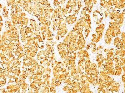 Immunohistochemistry-Paraffin: Melan-A/MART-1 Antibody (DT101+ BC199) - Azide and BSA Free [NBP2-34607] - Formalin-fixed, paraffin-embedded human melanoma stained with Melan-A MAb (DT101+BC199). Note cytoplasmic staining of cells.