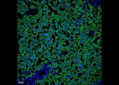 Immunohistochemistry-Paraffin: Melan-A/MART-1 Antibody (DT101+ BC199) - Azide and BSA Free [NBP2-34607] - Human Melanoma sample was stained for MART-1 positive cells, in green and counter-stained for DAPI in blue. This image was submitted via customer Review.