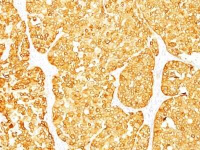 Immunohistochemistry-Paraffin: Melan-A/MART-1 Antibody (M2-7C10 + M2-9E3) - Azide and BSA Free [NBP2-34680] - Formalin-fixed, paraffin-embedded human melanoma stained withMelan-A MAb (M2-7C10+M2-9E3). Note cytoplasmic staining of cells.