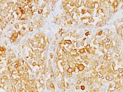 Immunohistochemistry-Paraffin: Melan-A/MART-1 Antibody (M2-9E3) - IHC-Prediluted [NBP2-44388] - Formalin-paraffin human melanoma stained with  Melan-A Ab (M2-9E3). Note cytoplasmic staining of cells.