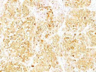Immunohistochemistry-Paraffin: Melan-A/MART-1 Antibody (M2-9E3) - IHC-Prediluted [NBP2-44388] - Formalin-paraffin human melanoma stained with  Melan-A Ab (M2-9E3). Note cytoplasmic staining of cells.