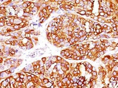 Immunohistochemistry-Paraffin: Melan-A/MART-1 Antibody (MLANA/1409R) - Azide and BSA Free [NBP2-54443] - Formalin-fixed, paraffin-embedded Human Melanoma stained with MART-1 Recombinant Rabbit Monoclonal Antibody (MLANA/1409R).