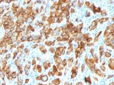 Immunohistochemistry-Paraffin: Melan-A/MART-1 Antibody (SPM540) - IHC-Prediluted [NBP2-44389] - Formalin-paraffin human melanoma stained with Melan-A MAb (SPM540). Note cytoplasmic staining of cells.