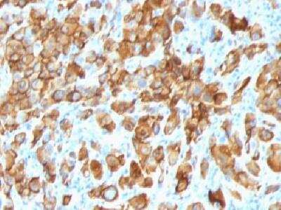 Immunohistochemistry-Paraffin: Melan-A/MART-1 Antibody (SPM540) [NBP2-32977] - Formalin-paraffin human melanoma stained with Melan-A MAb (SPM540). Note cytoplasmic staining of cells.