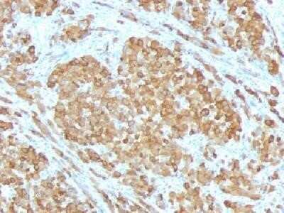 Immunohistochemistry-Paraffin: Melan-A/MART-1 Antibody (SPM555) - Azide and BSA Free [NBP2-34797] - Formalin-paraffin human melanoma stained with Melan-A MAb (SPM555). Note cytoplasmic staining of cells.