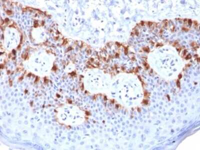 Immunohistochemistry-Paraffin: Melan-A/MART-1 Antibody (rMLANA/788) [NBP2-53293] - Formalin-fixed, paraffin-embedded human Melanoma stained with Melan-A Recombinant Mouse Monoclonal Antibody (rMLANA/788).