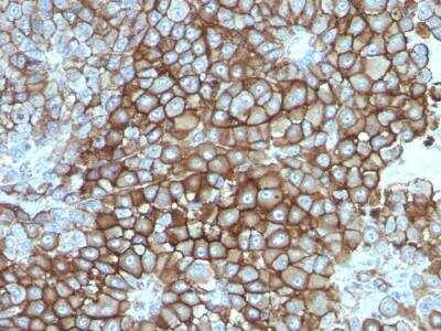 Immunohistochemistry-Paraffin: Melanoma Associated Antigen (KBA.62) Antibody (KBA.62) - IHC-Prediluted [NBP2-48210] - Formalin-fixed, paraffin-embedded human Melanoma stained with Melanoma Monoclonal Antibody (KBA.62).