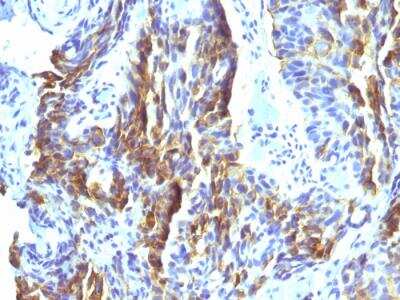 Immunohistochemistry-Paraffin: Melanoma Associated Antigen (KBA.62) Antibody (KBA.62) - IHC-Prediluted [NBP2-48210] - Formalin-fixed, paraffin-embedded human Tongue stained with Melanoma Monoclonal Antibody (KBA.62).