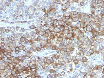 Immunohistochemistry-Paraffin: Melanoma Associated Antigen (PNL2) Antibody (PNL2) - IHC-Prediluted [NBP2-48231] - Formalin-fixed, paraffin-embedded human Melanoma stained with PNL2 Mouse Monoclonal Antibody.