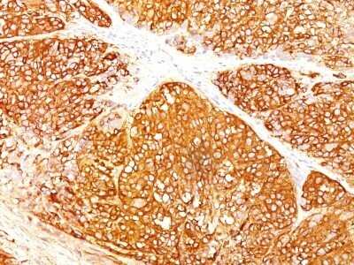 Immunohistochemistry-Paraffin: Melanoma Marker (MART-1 + Tyrosinase + gp100) Antibody (A103 + T311 + HMB45) - Azide and BSA Free [NBP2-34547] - Formalin-fixed, paraffin-embedded human melanoma stained with Melanoma Marker MAb (A103 + T311 + HMB45).