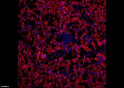 Immunohistochemistry-Frozen: Melanoma Marker (MART-1 + Tyrosinase + gp100) Antibody (M2-7C10 + M2-9E3 + T311 + HMB45) - Azide and BSA Free [NBP2-34681] - Melanoma Tissue stained for Mart-1 Tyrosinase p100 (red) counterstained with DAPI (blue). Image from a verified customer review.