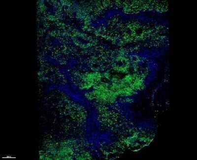 Immunohistochemistry: Melanoma Marker (MART-1 + Tyrosinase + gp100) Antibody (M2-7C10 + M2-9E3 + T311 + HMB45) - Azide and BSA Free [NBP2-34681] - Scan of human melanoma sample. Stained for Mart-1+Tyrosinase+gp100 (green) counter stained with DAPI (blue). Image from verified customer review. Image using the Janelia Fluor 549 format of this antibody.