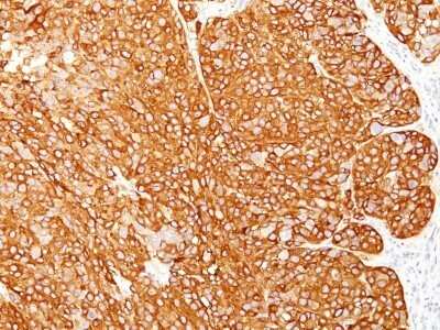 Immunohistochemistry-Paraffin: Melanoma Marker (MART-1 + Tyrosinase + gp100) Antibody (M2-7C10 + M2-9E3 + T311 + HMB45) - Azide and BSA Free [NBP2-34681] - Formalin-fixed, paraffin-embedded human melanoma stained with Melanoma Marker MAb (M2-7C10 + M2-9E3 + T311 + HMB45).