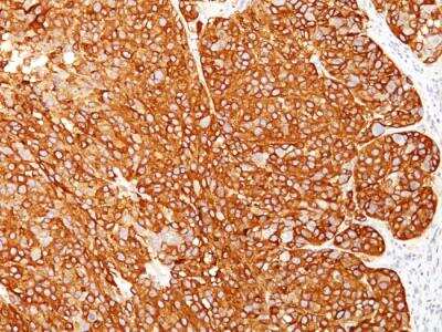 Immunohistochemistry-Paraffin: Melanoma Marker (MART-1 + Tyrosinase + gp100) Antibody (M2-7C10 + M2-9E3 + T311 + HMB45) - IHC-Prediluted [NBP2-48257] - Formalin-fixed, paraffin-embedded human Melanoma stained with Melanoma Marker Monoclonal Antibody (M2-7C10 + M2-9E3 + T311 + HMB45).