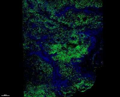 Immunocytochemistry/Immunofluorescence: Melanoma Marker (MART-1 + Tyrosinase + gp100) Antibody (M2-7C10 + M2-9E3 + T311 + HMB45) [Janelia Fluor® 549] [NBP2-34681JF549] - Scan of human melanoma sample. Stained for Mart-1+Tyrosinase+gp100 (green) counter stained with DAPI (blue). Image from verified customer review.