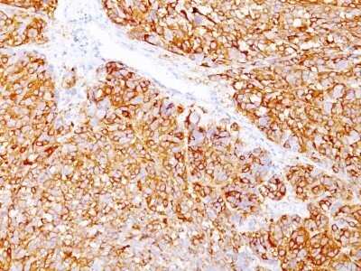 Immunohistochemistry-Paraffin: Melanoma Marker (MART-1 + gp100) Antibody (DT101+ BC199 + HMB45) - Azide and BSA Free [NBP2-34608] - Formalin-fixed, paraffin-embedded human Melanoma stained with Melanoma Marker (MART-1 + gp100) Antibody (DT101+ BC199 + HMB45).