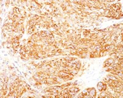 Immunohistochemistry-Paraffin: Melanoma Marker (MART-1 + gp100) Antibody (DT101+ BC199 + HMB45) - Azide and BSA Free [NBP2-34608] - Formalin-fixed, paraffin-embedded human melanoma stained with Melanoma Marker  MAb (DT101+ BC199 + HMB45).