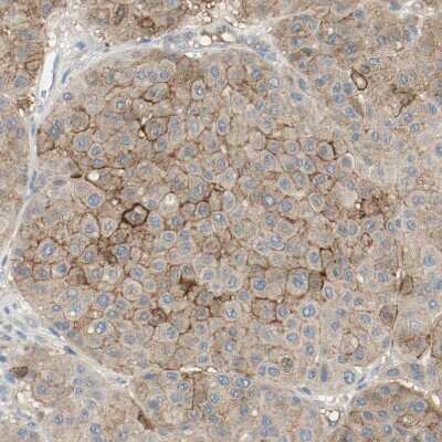 <b>Orthogonal Strategies Validation. </b>Immunohistochemistry-Paraffin: Melanotransferrin/CD228/MFI2 Antibody [NBP1-85777] - Staining of human malignant melanoma shows moderate membranous positivity in tumor cells.