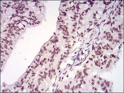 Immunohistochemistry-Paraffin: Menin Antibody (7D3E10) [NBP2-37251] - Analysis of rectum cancer tissues using MEN1 mouse mAb with DAB staining.