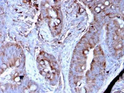 Immunohistochemistry-Paraffin: Mer Antibody (MERTK/3024) [NBP3-13839] - Formalin-fixed, paraffin-embedded human Colon Carcinoma stained with Mer antibody (MERTK/3024).