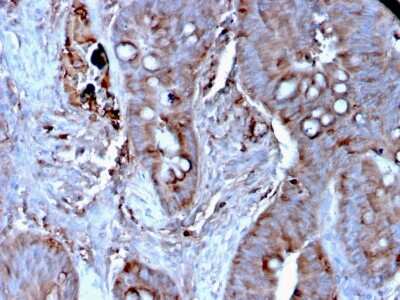 Immunohistochemistry-Paraffin: Mer Antibody (MERTK/3024) [NBP3-13839] - Formalin-fixed, paraffin-embedded human Colon Carcinoma stained with Mer antibody (MERTK/3024).