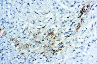 Immunohistochemistry: Mesothelin Antibody (YP158) [NBP2-75255] - Mesothelioma stained with Mesothelin Clone YP158 25x