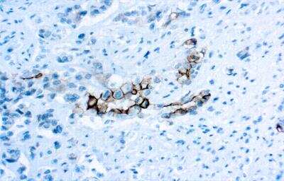 Immunohistochemistry: Mesothelin Antibody (YP158) [NBP2-75255] - Mesothelioma stained with Mesothelin Clone YP158 25x